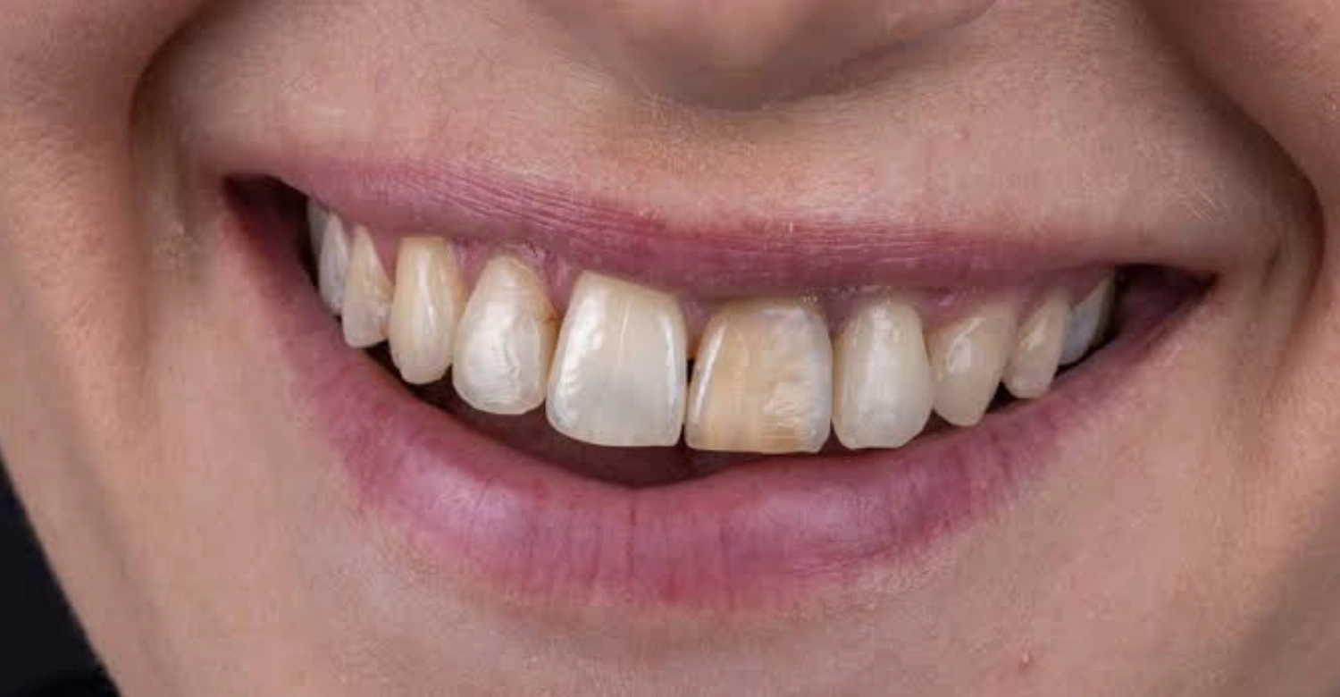 Teeth Discoloration Inblog